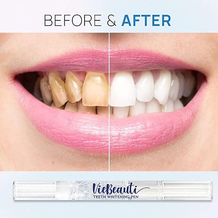Serum de blanchiment des dents BF